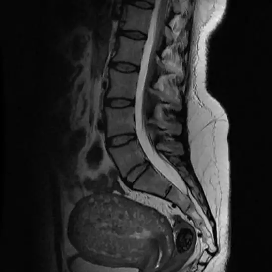 MRI Coccyx
